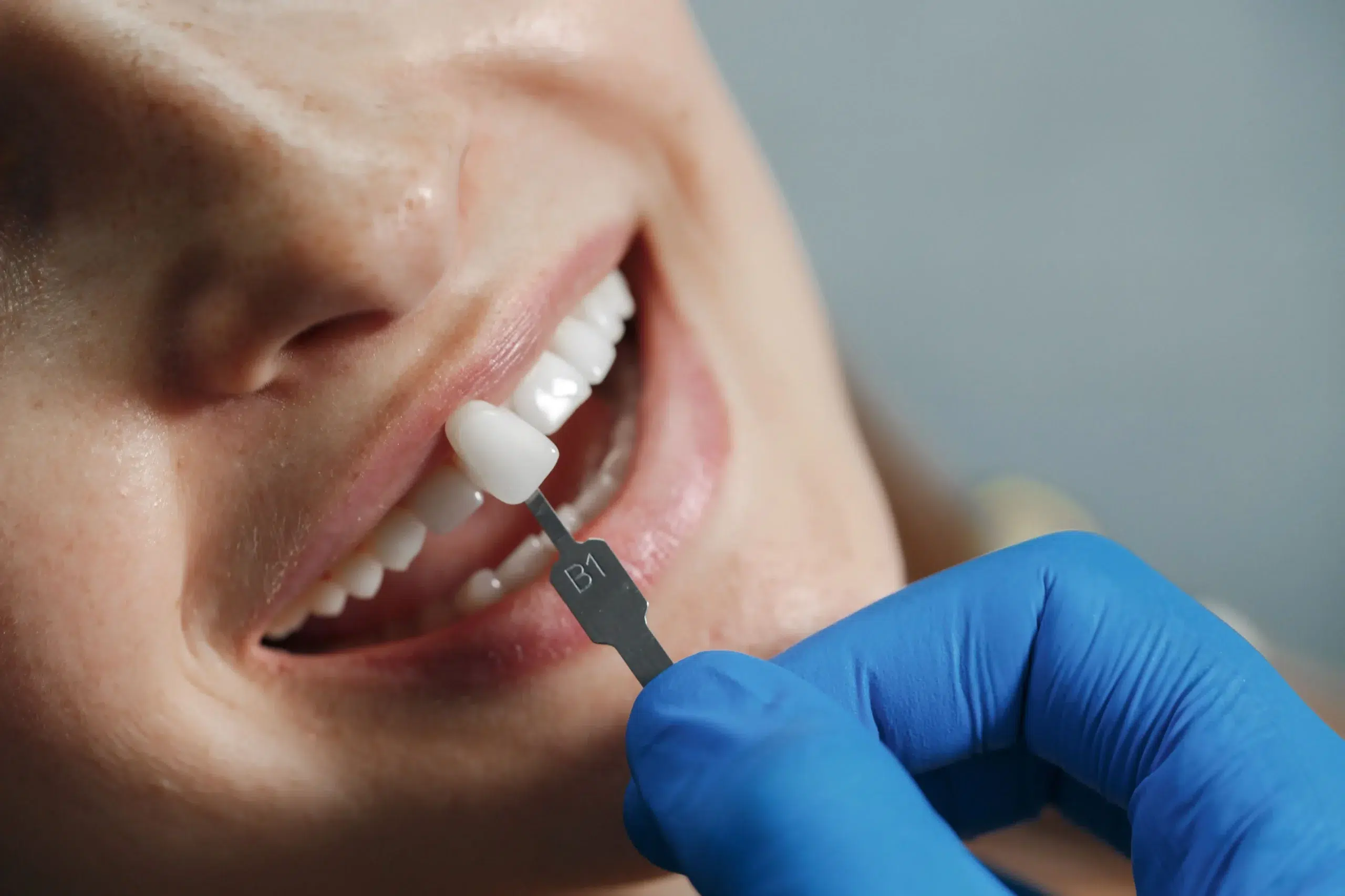 carillas dentales en baiona clinica dental barros